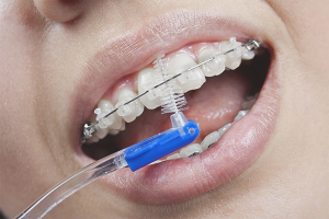Kuinka harjata hampaita hammasrakoilla