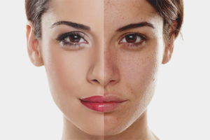 Hoe de huid egaliseren na acne